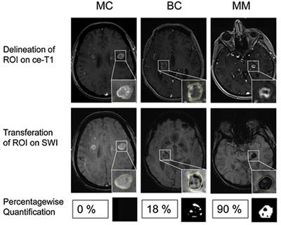 Clinical Value of Susceptibility Weighted Imaging of Brain Metastases